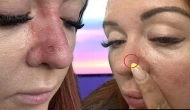 Hafife alınmaması gereken bir sorun: Sıradan bir sivilce sandı, ama hayatı altüst oldu! 2 binden fazla kişinin ölümüne sebep oluyor.