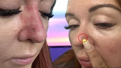 Hafife alınmaması gereken bir sorun: Sıradan bir sivilce sandı, ama hayatı altüst oldu! 2 binden fazla kişinin ölümüne sebep oluyor.