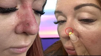 Hafife alınmaması gereken bir sorun: Sıradan bir sivilce sandı, ama hayatı altüst oldu! 2 binden fazla kişinin ölümüne sebep oluyor.